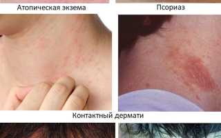 Зуд в области шеи