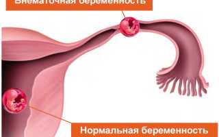 Боли в животе на раннем сроке беременности