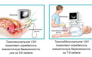 Как определить внематочную беременность и исключить патологию на раннем сроке