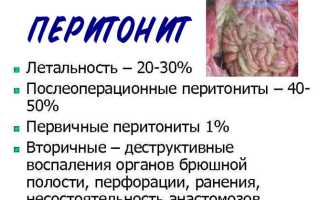 Что такое перитонит, чем он опасен и как лечится
