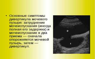 Что такое дивертикул пузыря — как распознать столь скрытое заболевание