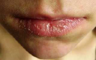 Экзема на губах