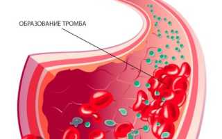 О чём важно знать будущей маме при тромбоцитопении