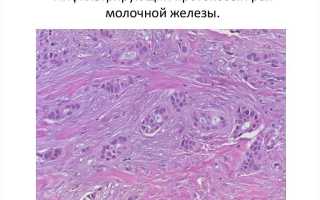 Виды карциномы молочной железы