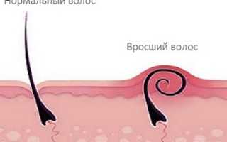 Вросшие волосы в зоне бикини