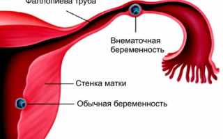Что такое внематочная беременность: различные аспекты проблемы