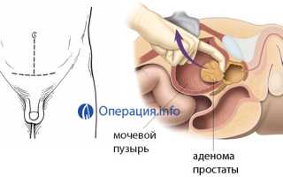 Малоинвазивные операции на простате