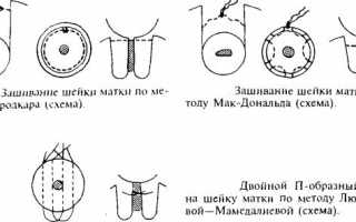 Чем опасна истмико-цервикальная недостаточность при беременности: причины возникновения и методы лечения ИЦН