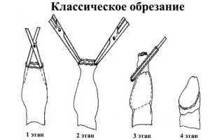 Что такое циркумцизия: плюсы и минусы процедуры