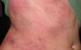 Боль в правом боку под ребрами